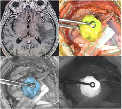 Fluorescence-Guided Surgery: A Review on Timing and Use in Brain Tumor Surgery